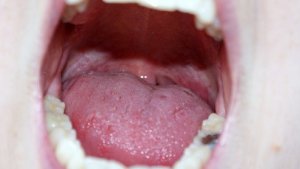 Hpv e cancro: se per la diagnosi basta un tampone