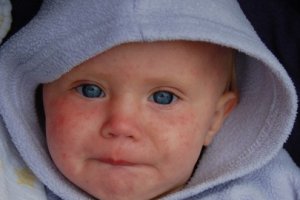 Epidemie di Morbillo, Italia al primo posto nell'Ue