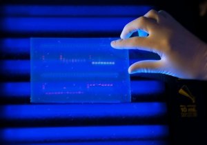Sclerosi multipla, identificata la prima mutazione genica della forma più grave