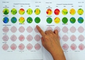 La sindrome dell'accento straniero