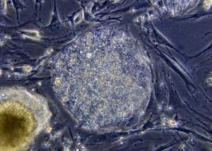 Inchiesta, Ccsvi e SM la posizione dei neurologi (seconda parte)