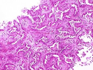 Cancro polmonare, scoperto nuovo meccanismo di freno