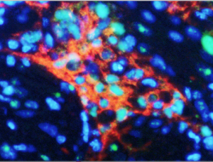 Cancro, scoperto il legame proteico che va fermato