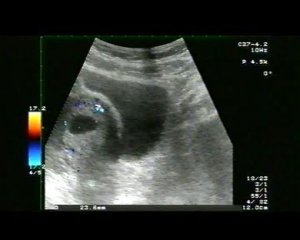 Aborti, nel 2009 scesi del 3,6 per cento