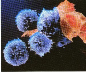 Aids: oltre il preservativo.