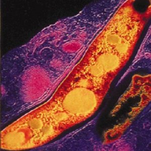 XDRTB, La nuova tubercolosi ed il rischio di una nuova pandemia