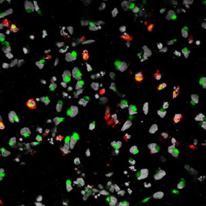 Zika virus: scoperto possibile rapporto con la microcefalia