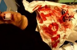 NoTav, la denuncia di un uomo sfigurato da lacrimogeni sparati sulla folla