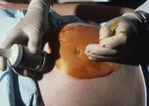 Gravidanza: nuovo test per sostituire l'amniocentesi