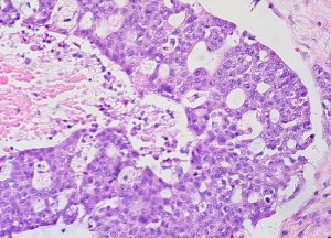 Cancro ovarico: tracciata la mappa molecolare