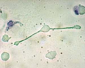 Leucemia linfatica cronica: verso una terapia risolutiva?